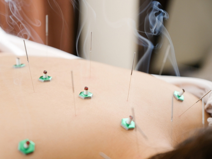 鍼・灸治療