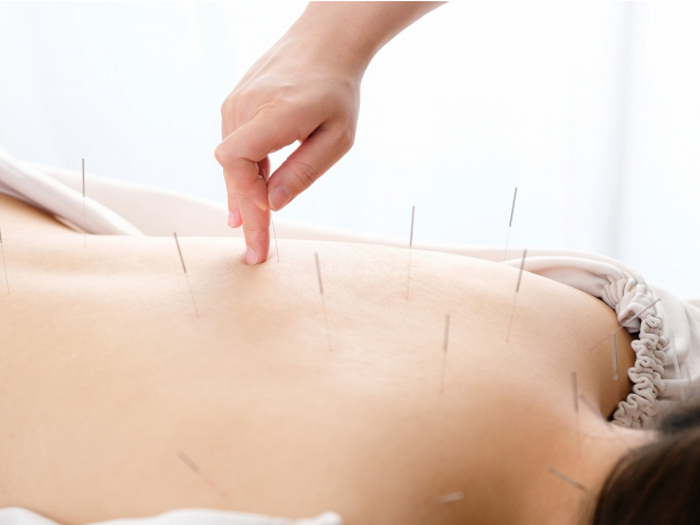 鍼治療（撚鍼術）